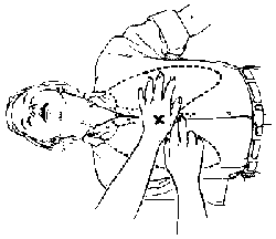 Another Example of First Aid for PSP Victims